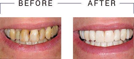 The image shows a person s smile before and after teeth whitening treatment, with two photos placed side by side.