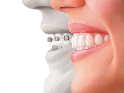 The image shows a comparison between a person s natural teeth and the appearance of their teeth after dental treatment, with a focus on the difference in smile aesthetics.