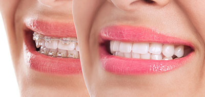 The image features a person s smiling face with teeth, showcasing dental braces and lipstick.