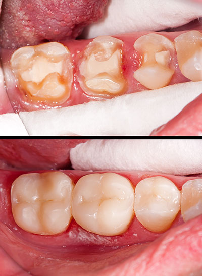 The image shows a close-up view of a person s teeth with dental work being done, specifically showing a tooth with a large filling and some decay, along with an open mouth and tongue, set against a medical background.
