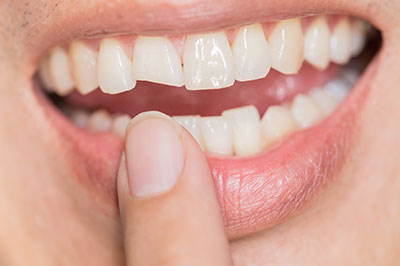 The image shows a close-up of someone s mouth with a partial denture and teeth, displaying a smile with a focus on a visible dental issue, possibly related to oral hygiene or cosmetic concerns.