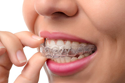 The image shows a person with braces, holding their teeth while smiling, with a focus on the smile and the braces.