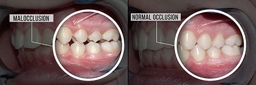 The image shows a series of four photographs with a person s mouth, featuring a tooth extraction process from start to finish.