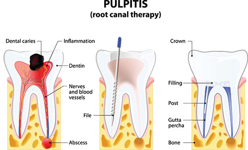 The image depicts a diagrammatic illustration of a tooth with annotations showing various parts of a dental pulp cavity, including the root canal therapy process.