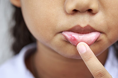 A close-up photo of a child s face with a noticeable pimple on their nose, looking directly at the camera with a finger placed over their mouth.