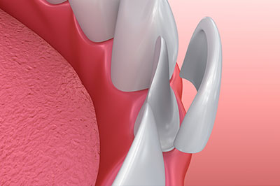 This image features a close-up view of a dental implant with a pink gum background and a partial tooth crown, likely illustrating a dental procedure or product.