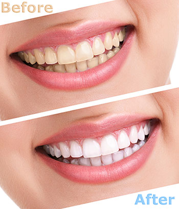 The image shows a before-and-after comparison of teeth whitening, with two photos side by side  on the left, a close-up of a person s mouth showing yellowish teeth, and on the right, the same mouth with significantly brighter, white teeth after the teeth whitening process.