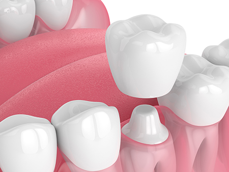 The image displays a close-up photograph of artificial teeth with a pink gumline and toothpaste, arranged neatly together against a white background.