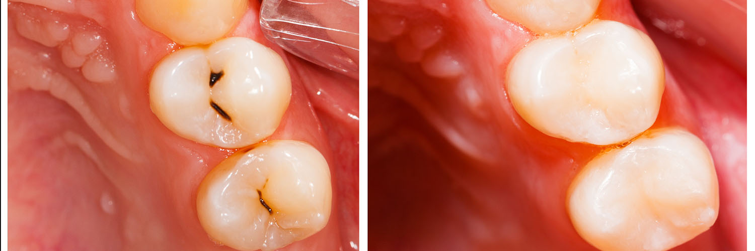 The image shows a close-up view of a person s mouth with a tooth being extracted, where the tooth has been partially removed and there are visible signs of inflammation and infection around the extraction site.