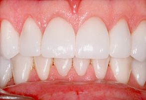 The image displays a person s teeth with an enlarged view of the lower front teeth, showcasing their alignment and condition, likely for dental care or cosmetic purposes.