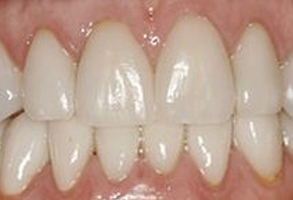 The image displays a close-up view of a person s teeth with an emphasis on a dental implant, showcasing its appearance and integration into the surrounding natural teeth.
