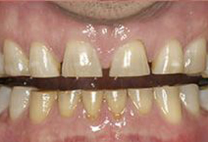 The image shows a close-up view of a person s teeth with visible yellow staining and a partial metal wire across the front, suggesting a dental orthodontic treatment process.