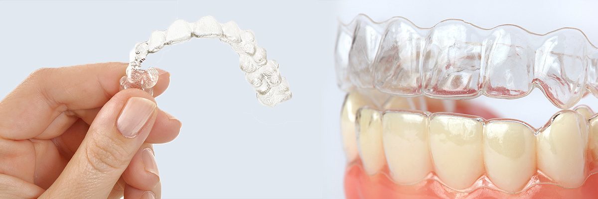 Invisalign - An Invisible Solution To Straighten Teeth - Diamond Head  Dental Care Honolulu Hawaii